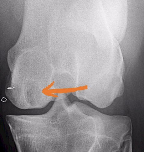 X-rays showing how a similar cyst in the stifle was fixed with a screw