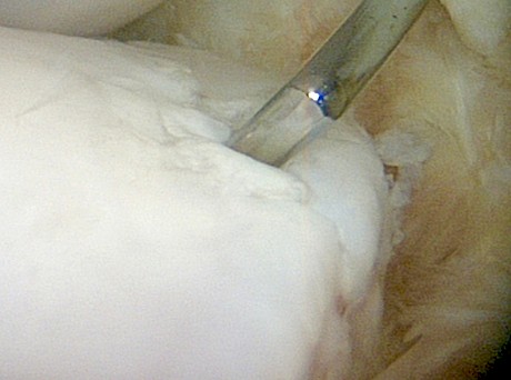 Pictures of arthroscopic carpal chip surgery similar to that carried out on Lincoln Raider. The probe is against a loose bone fragment and cartilage surfaces are rough when they should be extremely smooth.