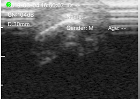 How Cru Bourgeois’ undamaged right zygomatic arch looked on ultrasound. Compare it with how his left eye looks in the main image.