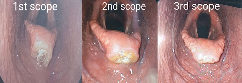 Three scopes show the recovery of O’Reilly’s Dancer’s infected epiglottis.