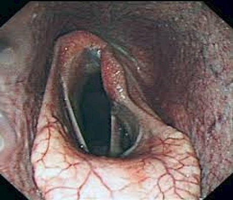 In left-sided laryngeal hemiplegia the vocal cord collapses into the midline of the larynx, obstructing the entire airway.