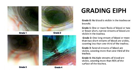 What the endoscope finds in the horse’s airway with varying grades of bleed.